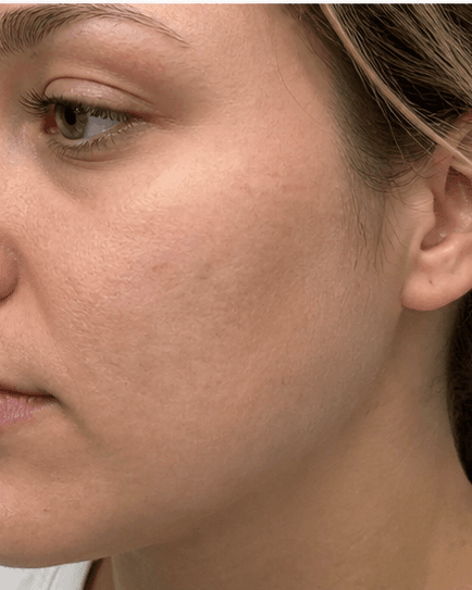 Microneedling for Scars: after