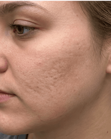 Microneedling for Scars: before