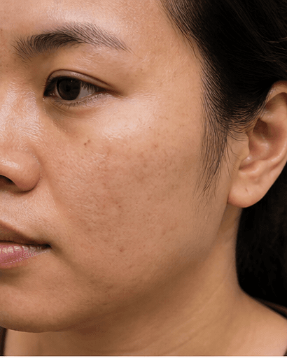 Post-Acne Mark Fading: after