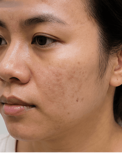 Post-Acne Mark Fading: before