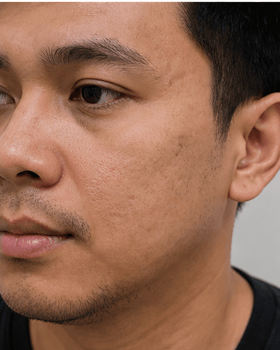 Post-Acne Mark Fading: after