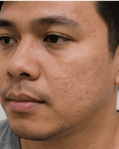 Post-Acne Mark Fading: before