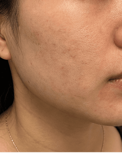 Post-Acne Mark Treatment: after