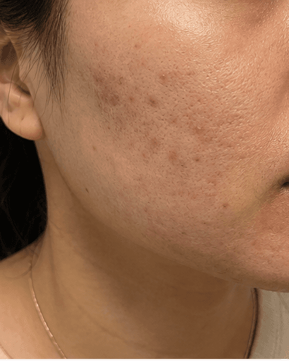 Post-Acne Mark Treatment: before