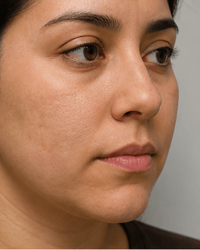 Salicylic Acid Peel: after