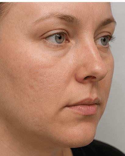 Salicylic Acid Peel: after