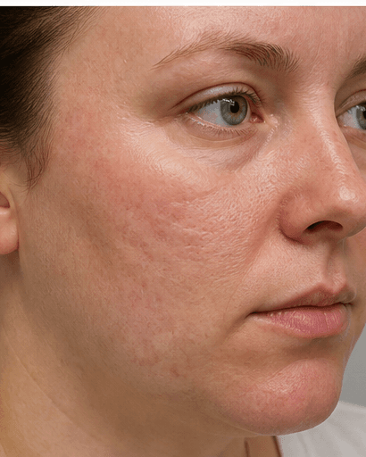 Salicylic Acid Peel: before