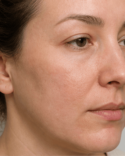 Scar Filling: after