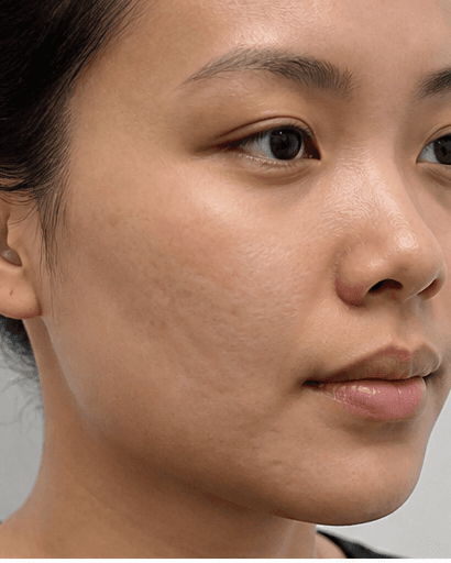 Acne Scar Revision: after