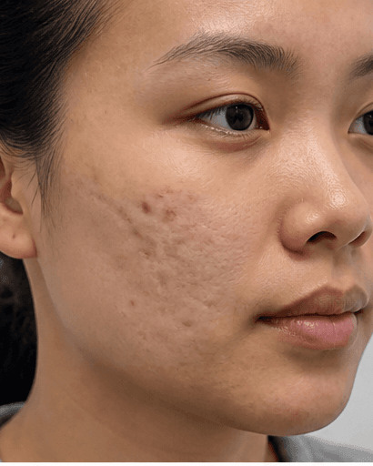 Acne Scar Revision: before