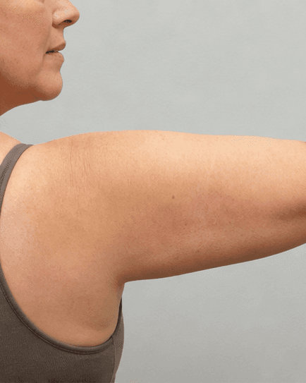 Arm Contouring: after