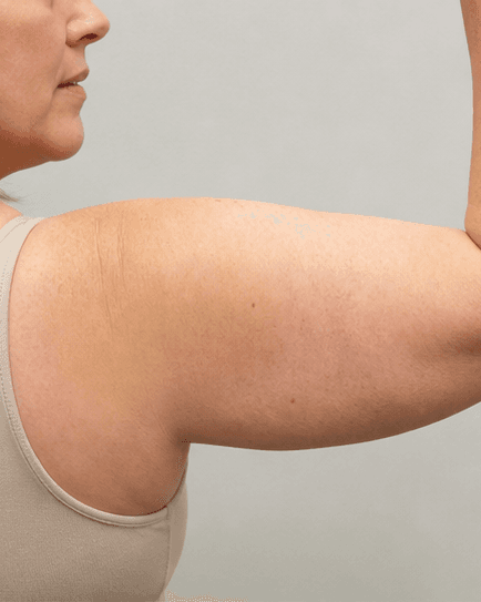 Arm Contouring: before