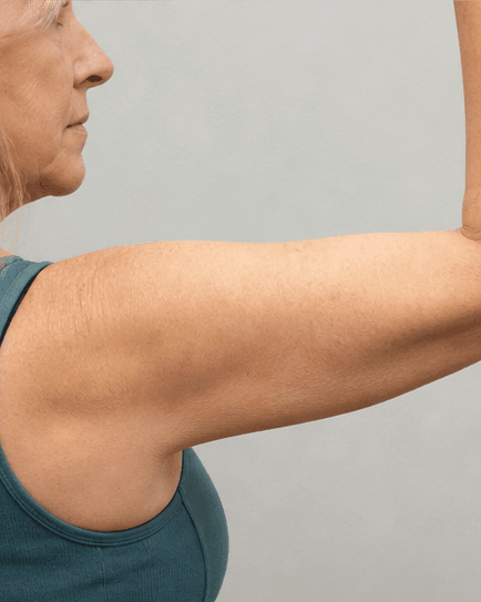 Arm Contouring: after