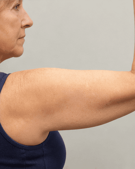 Arm Contouring: before