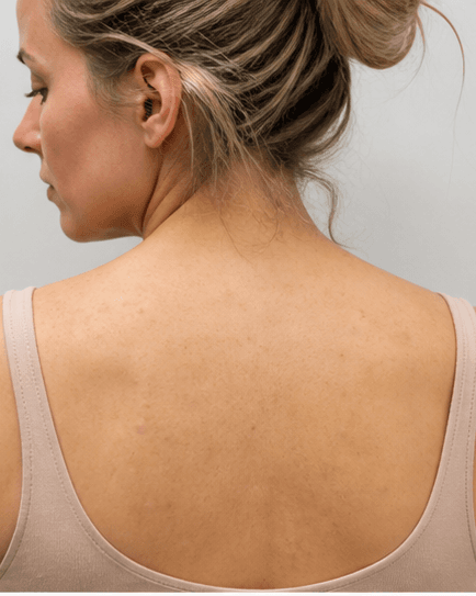 Back & Body Acne: after