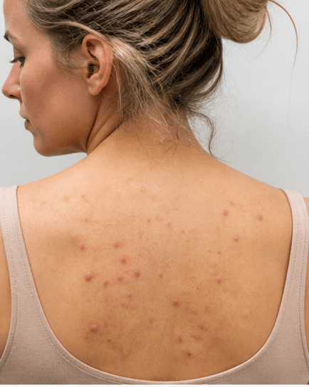 Back & Body Acne: before