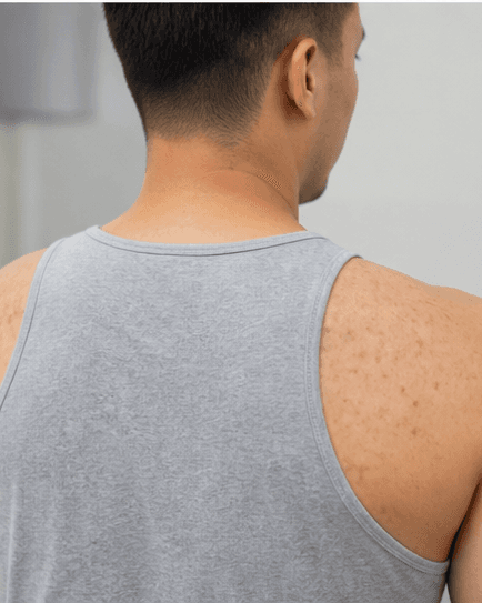 Back & Body Acne: before