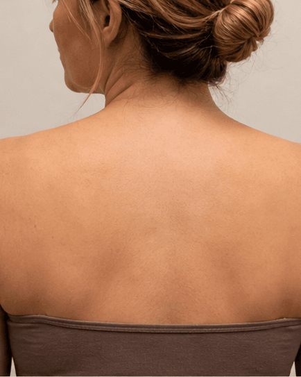 Back & Bra Line: after