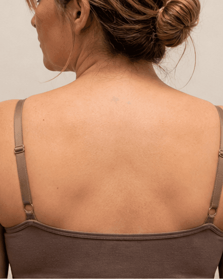 Back & Bra Line: before