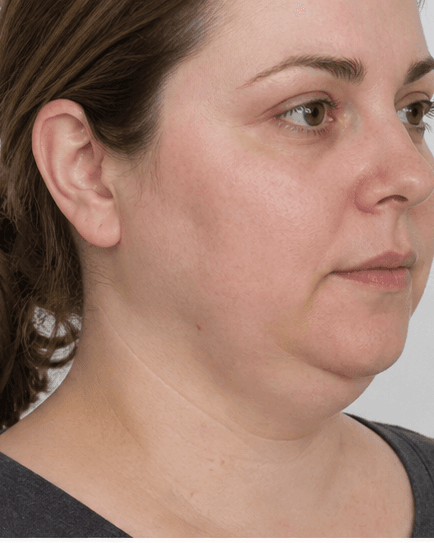 Fat Dissolving (Lipolysis): before