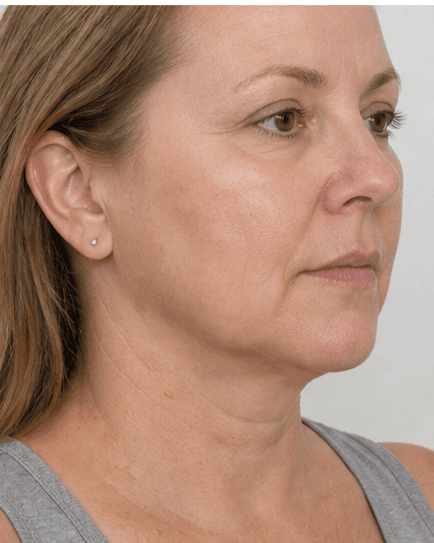 Fat Dissolving (Lipolysis): after