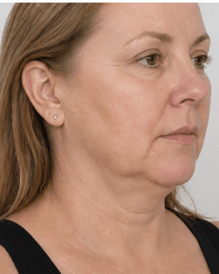 Fat Dissolving (Lipolysis): before