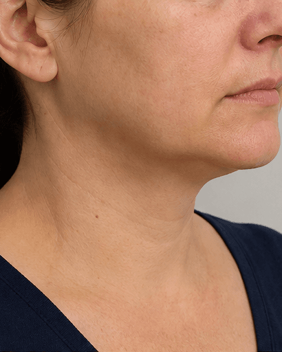 Injection Lipolysis: after