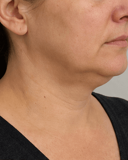 Injection Lipolysis: before