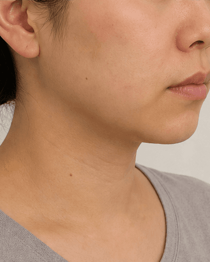 Injection Lipolysis: after