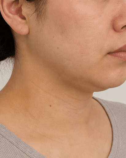 Injection Lipolysis: before