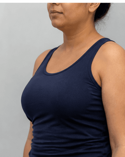 Body Skin Tightening: after