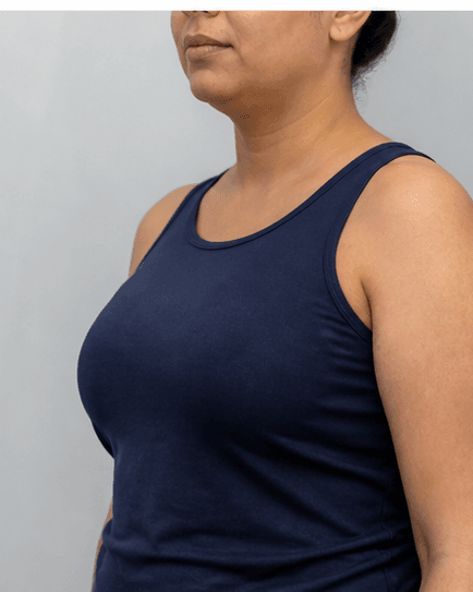 Body Skin Tightening: before