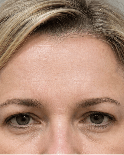 Anti-Wrinkle (Forehead & Frown): after