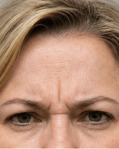 Anti-Wrinkle (Forehead & Frown): before