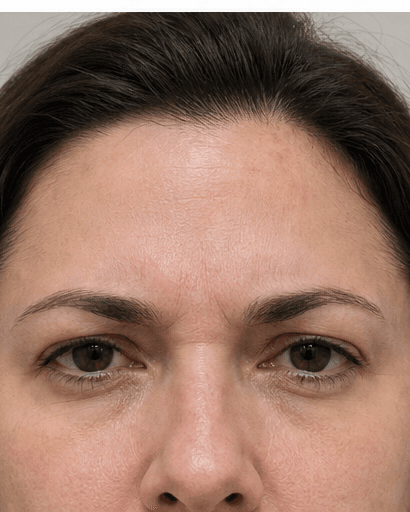 Anti-Wrinkle (Forehead & Frown): after