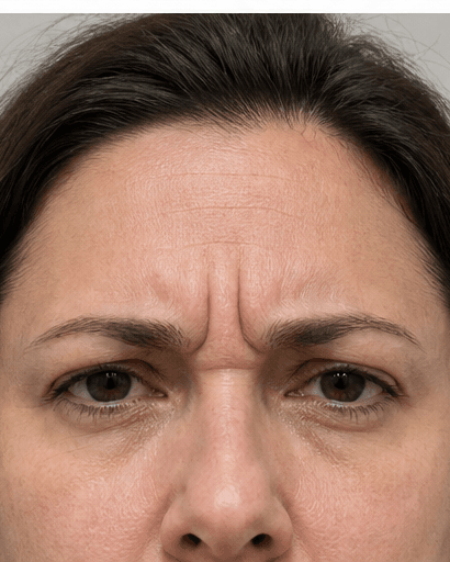 Anti-Wrinkle (Forehead & Frown): before