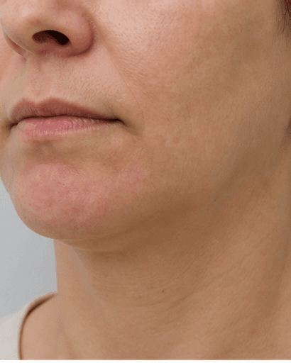 Chin Dimpling: after