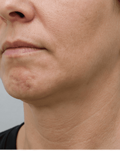 Chin Dimpling: before