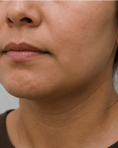 Chin Dimpling: after