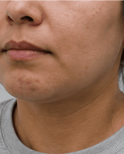 Chin Dimpling: before