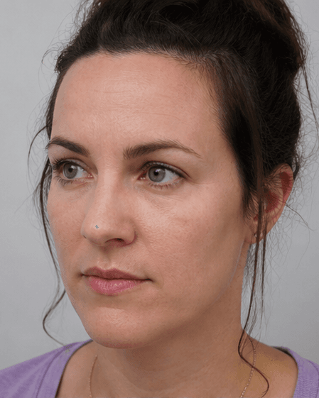 Forehead Lines: after