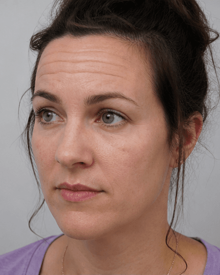 Forehead Lines: before