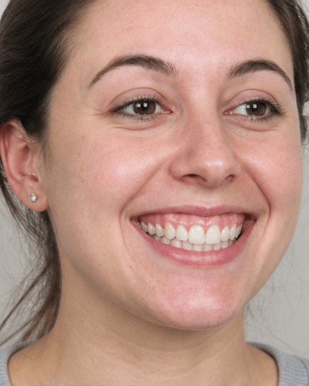 Gummy Smile Correction: before