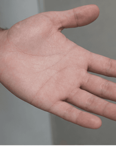 Palm Sweat Treatment: after