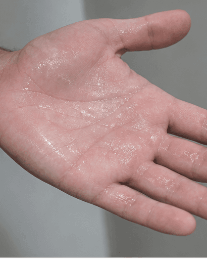 Palm Sweat Treatment: before