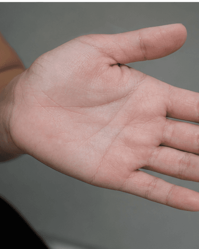Palm Sweat Treatment: after