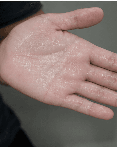 Palm Sweat Treatment: before