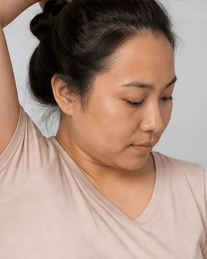 Underarm Sweat Treatment: after