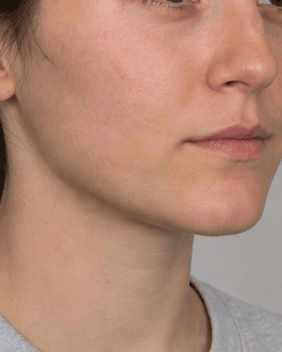 Lip Flip: after