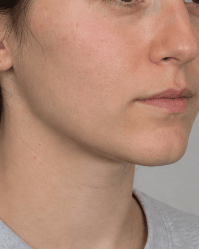 Lip Flip: before